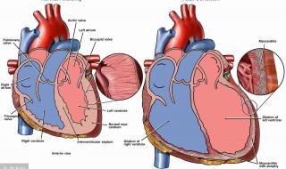 儿童心肌炎有三种表现 请问心肌炎有那些表现